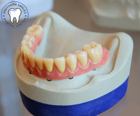 Get complete set of dentures in one day